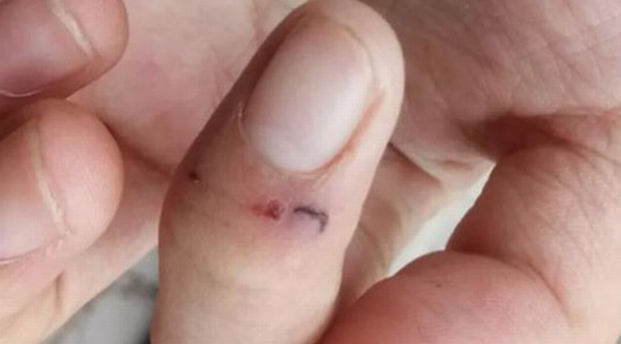 被鼠咬注射疫苗，保險公司卻不報銷|滅鼠